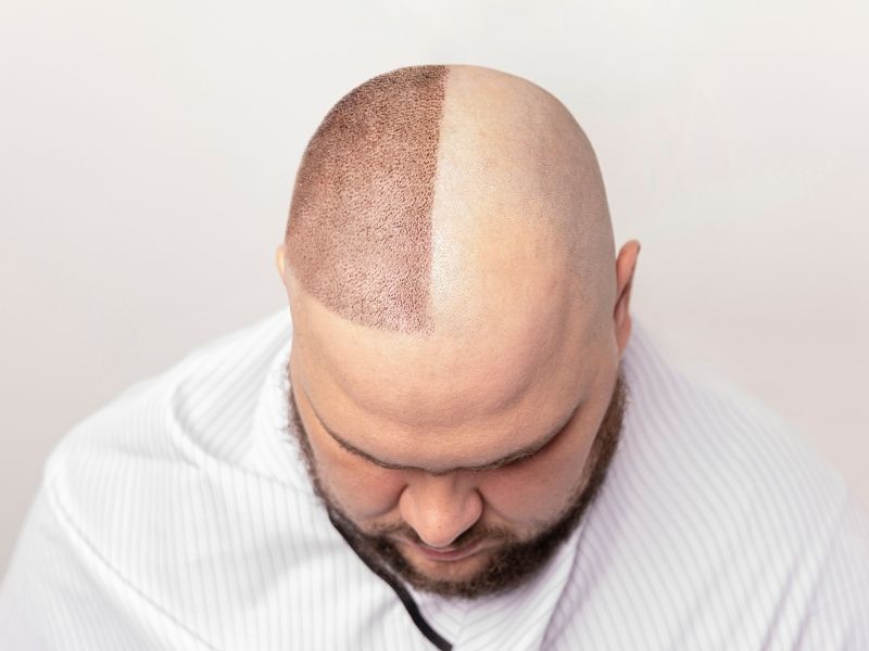 Hair Transplant